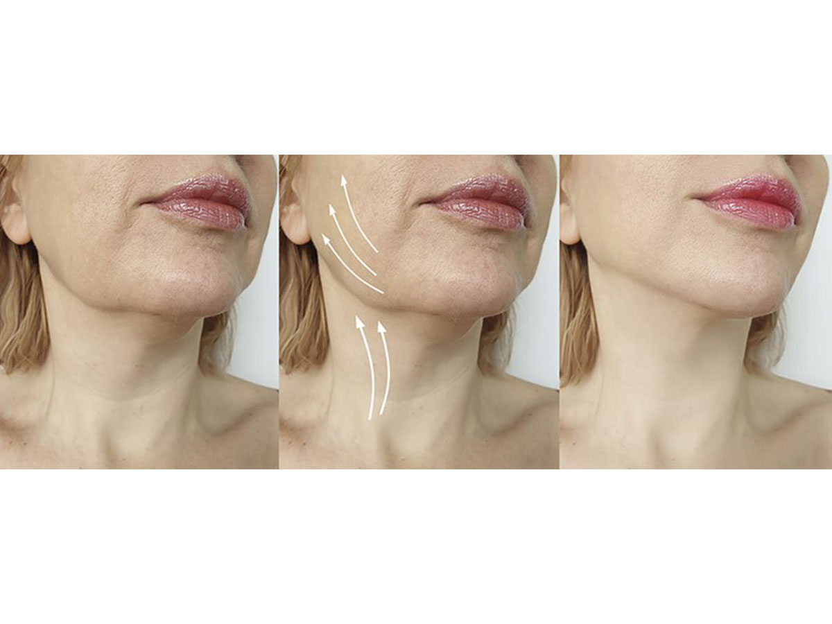 Radiofrequency Facial Skin Tightening